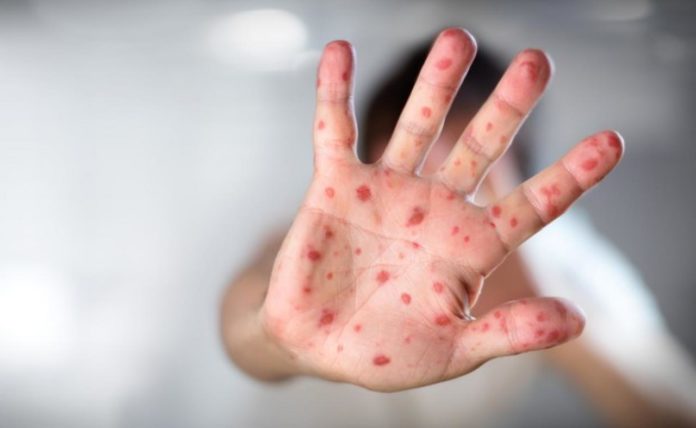 Мешканці Львівщини можуть безкоштовно вакцинуватися від кору препаратами з Бельгії та США Мешканці Львівщини можуть безкоштовно вакцинуватися від кору препаратами з Бельгії та США