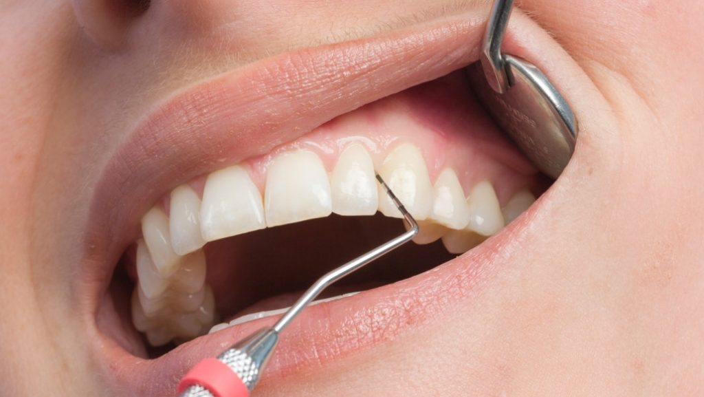 Лікарі припускають, що COVID-19 може пошкоджувати зуби і ротову порожнину
