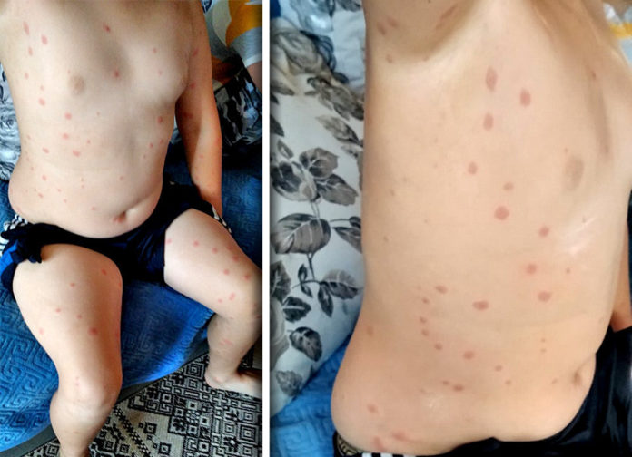 У моршинському озері заборонили купатися через загадкові висипи в дітей У моршинському озері заборонили купатися через загадкові висипи в дітей