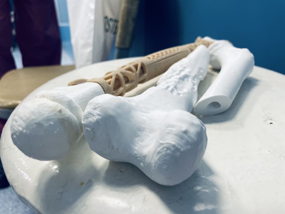 У Львові онкохворому хлопчику пересадили кістку, надруковану на 3D-принтері - 2