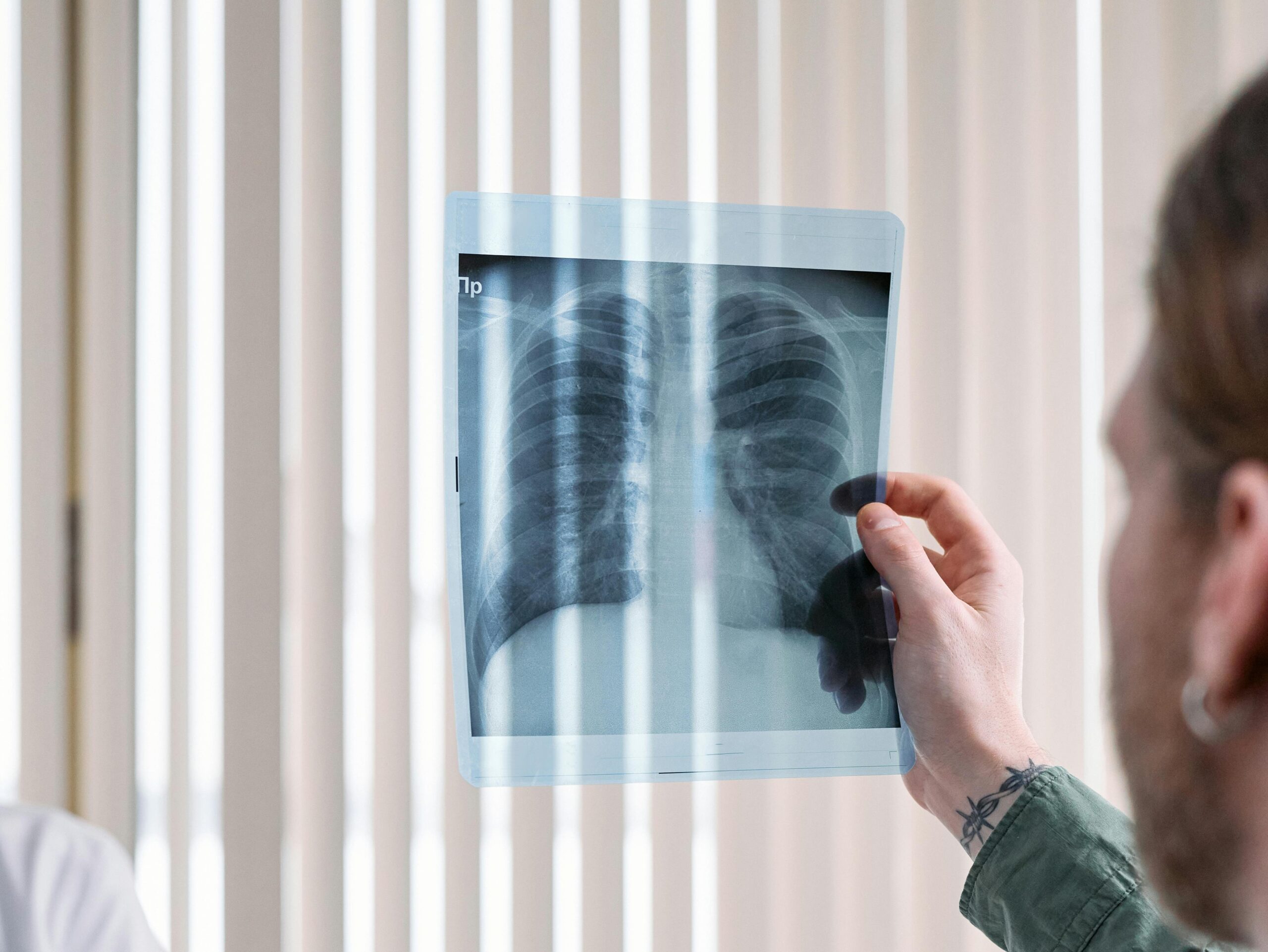 туберкульоз